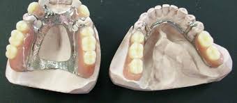 Cast Partial Dentures